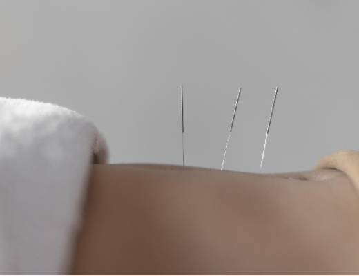 Best Acupuncture Treatments For Weight Loss Singapore