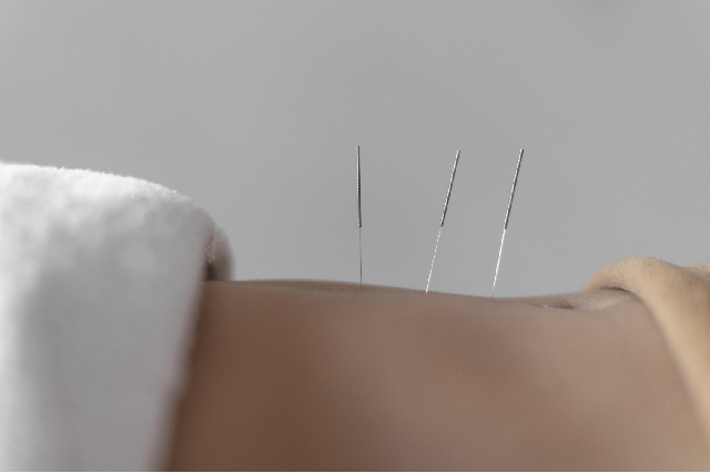 5 Best Weight Loss Acupuncture Treatments In SG