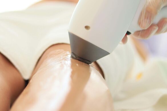 Best SHR Leg Hair Removal Singapore