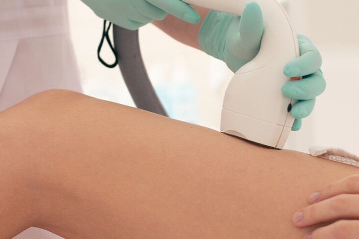 Smuvve SHR Leg Hair Removal Singapore